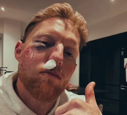 Stokes Highlights Safety Concerns Following Facial Injury.webp