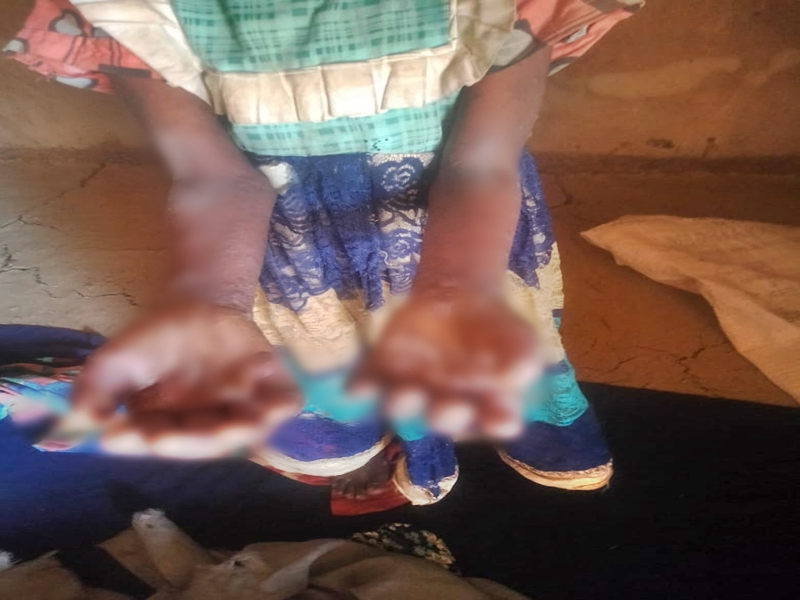 Betul District Faces Skin Disease Outbreak; Officials Called Upon.webp