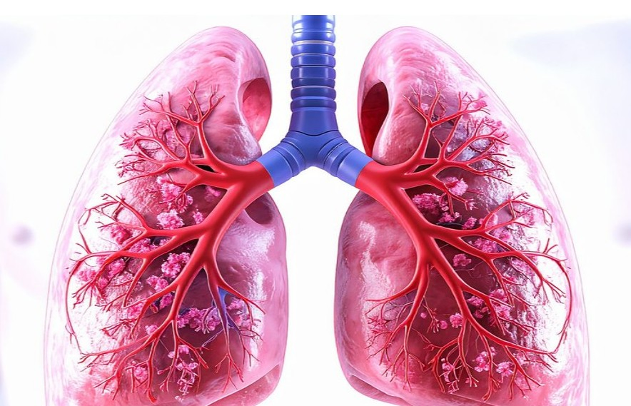 State Improves TB Treatment with Financial Support.webp