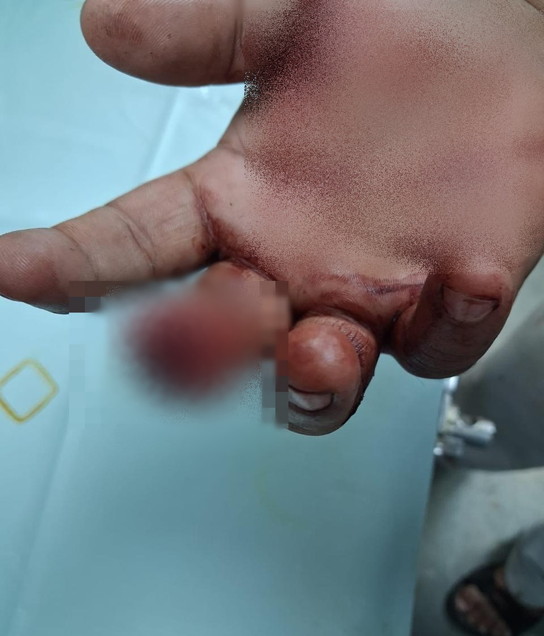Incident at Mumbai Samosa Shop: Man Arrested for Finger Bite.webp Incident at Mumbai Samosa Shop: Man Arrested for Finger Bite.webp
